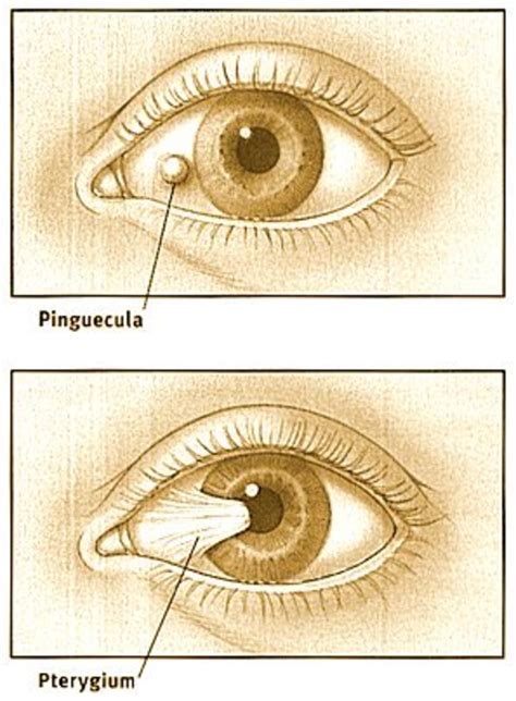 Pinguecula Risk Factors Diagnosis Treatment Complications 57 Off