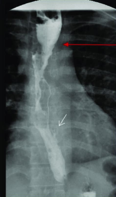 Esophagram 1 day postprocedure showing improvement in proximal thoracic... | Download Scientific ...