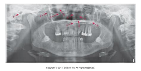 Radiology Pano Landmarks Flashcards Quizlet