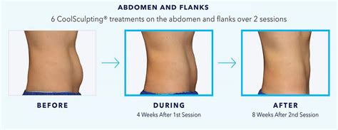 Coolsculpting Before During And After Images Real Patient Results