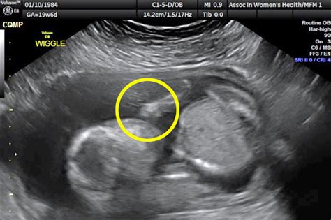 Unborn baby caught on camera doing bizarre thing during ultrasound scan ...