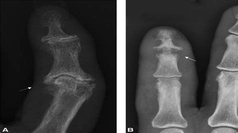 A Systematic Approach To Radiographic Evaluation Of Arthriti