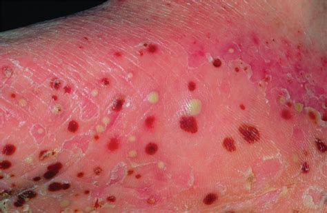 Generalised Pustular Psoriasis