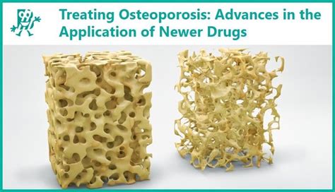 Treating Osteoporosis Advances In The Application Of Newer Drugs