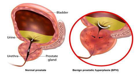 What Are The Symptoms Of BPH HALO Diagnostics