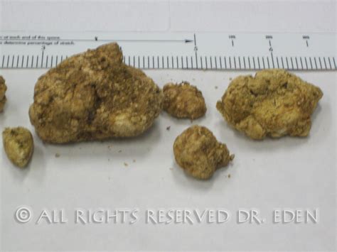 Gallstone Pictures Gallery See Images Of Real Gallstones Passed