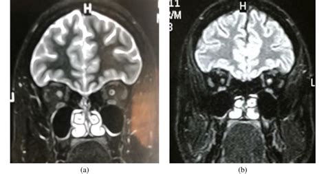 [Patient 30-Left Optic neuritis]: MRI T2/FLAIR coronal image shows ...