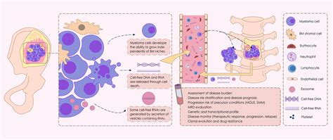 Schematic illustration of liquid biopsy in multiple myeloma (MM). We ...