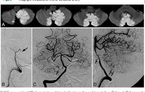 Figure I From Teaching Neuroimages Bilateral Cerebellar Infarction In Dominant Superior And