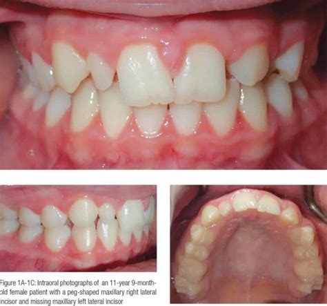 Peg Shaped Maxillary Lateral Incisors — A Dilemma