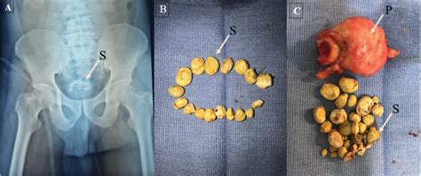 Multiple Stones in the Bladder - MEDizzy Journal