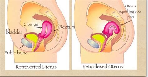 Retroverted Tilted Uterus Causes Symptoms Fertility 44 Off