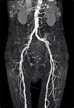 Computed Tomography Angiography Cta Charter Radiology