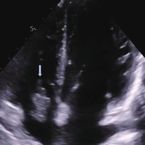 Follow Up Transthoracic Echocardiogram Showing Resolution Of The Right