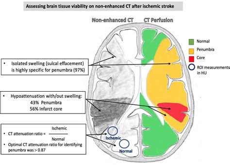 Assessing Brain Tissue Viability On Nonenhanced Computed Tomography