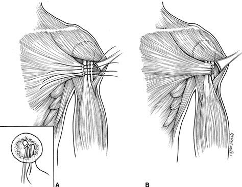 Pectoralis Major Tendon Rupture