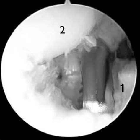 1) Olecranon fossa. 2) Olecranon. | Download Scientific Diagram