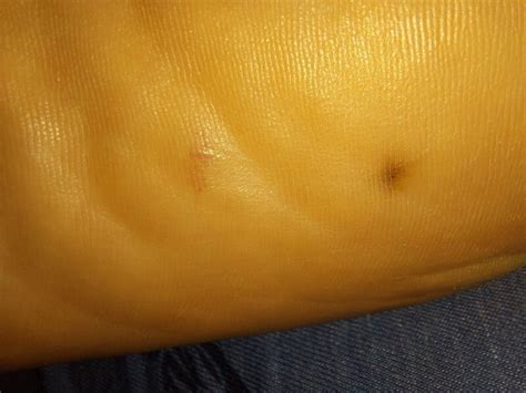 Black Spot Appeared On My Foot Top Sellers Emergencydentistry