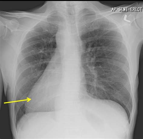 Isolated Dextrocardia Radiology Cases