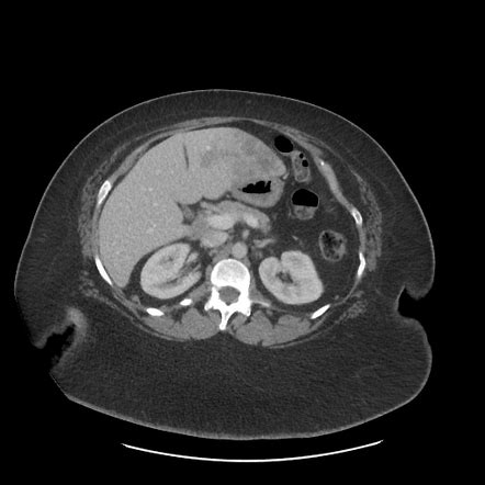 Cholangiocarcinoma Mass Forming Intrahepatic Radiology Case