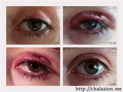 Chalazion.Me | Surgical operation for my encysted chalazion