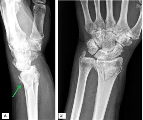 Fracture De Pouteau Colles Pdf