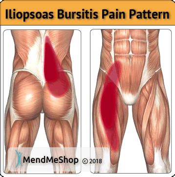 Iliopsoas Bursitis Causes Symptoms The Best Treatment