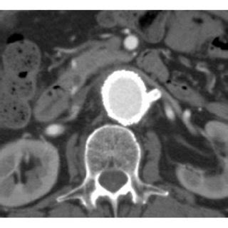 A Preoperative 3 Dimensional Computed Tomography With The Left