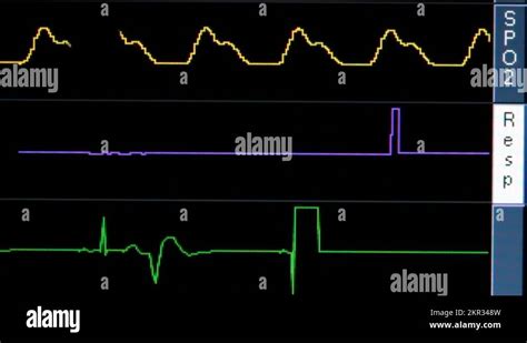 Flatline ecg Stock Videos & Footage - HD and 4K Video Clips - Alamy