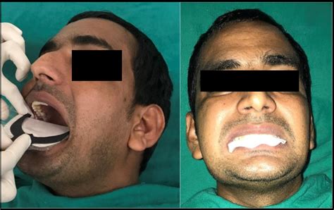 Bite force measurment of patien using prescale fujifilm | Download ...