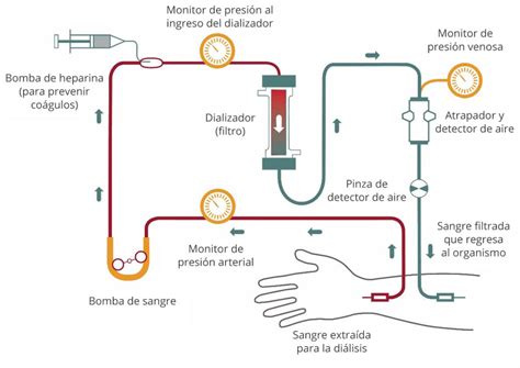 Técnicas De Hemodiálisis Hemodiálisis Fuentes Ecatepec