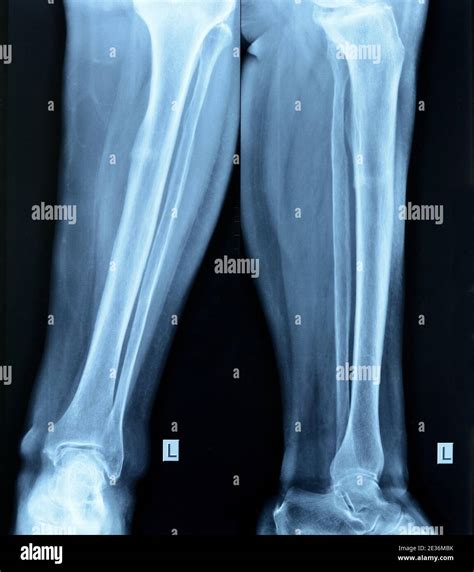 Tibia Fibular Fracture Stockfotos Und Bilder Kaufen Alamy