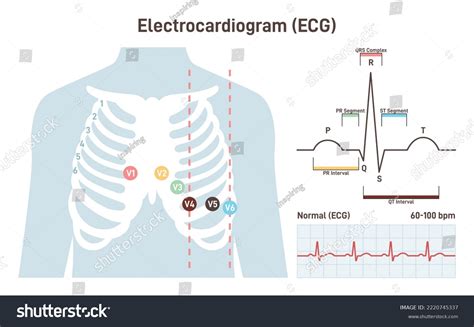 Lead Ecg Images Stock Photos Vectors Shutterstock