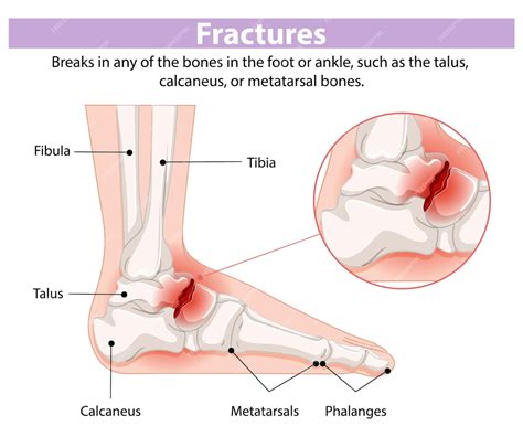 Premium Vector | Foot and Ankle Fracture Diagram