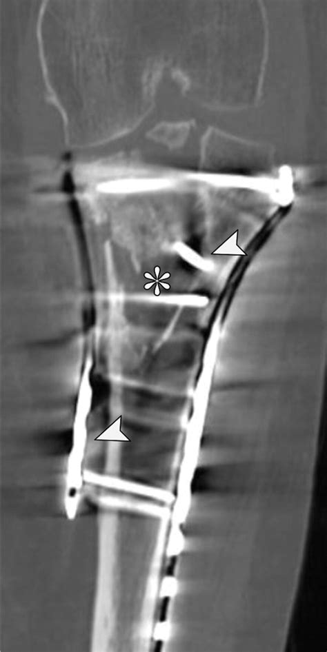 Three Column Classification System For Tibial Plateau Fractures What