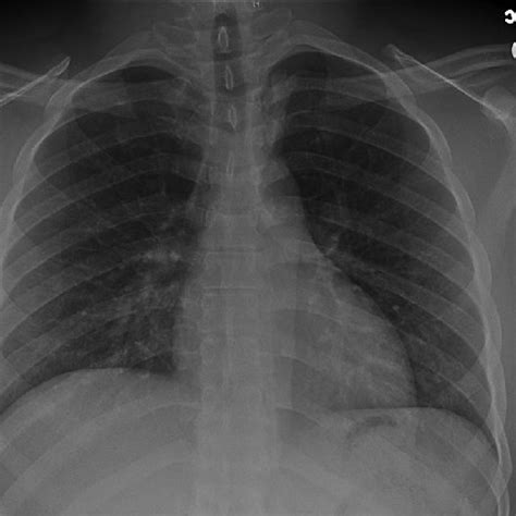 A Postero Anterior Chest Radiograph In The Same Patient H Later