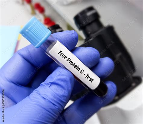 Blood sample for free protein S test to diagnosis of coagulation ...