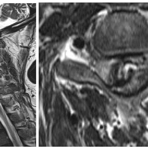 Cervical MRI shows the cervical spinal cord compression due to an ...