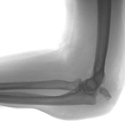 Olecranon Fracture Fixation | Elbow Surgeon | South Windsor, Rocky Hill ...