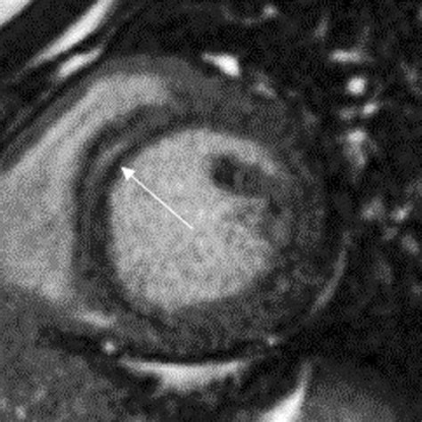 Cardiac Magnetic Resonance End Diastolic And End Systolic Still Frames