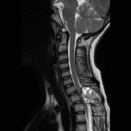 Spinal aneurysmal bone cyst | Radiology Case | Radiopaedia.org