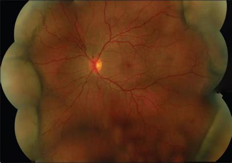 deepen  understanding  uveal effusion syndrome retinal physician