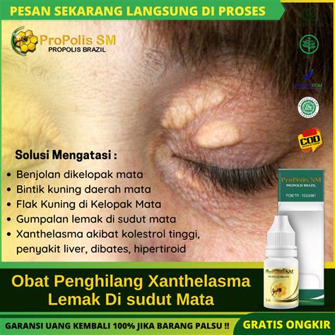 Obat Penghilang Xanthelasma Flak Kuning Di Kelopak Mata Dengan Propolis