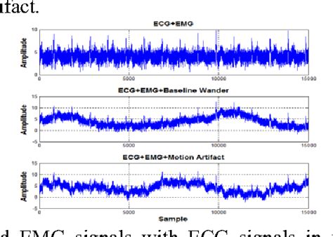 Pdf Ecg Detection Using A Convolution Wavelet Algorithm For Denoising