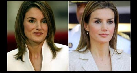 La Reina Letizia antes y después de sus presuntas cirugías