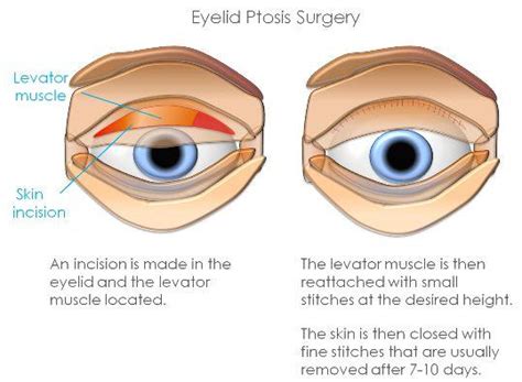 Ptosis Singapore Causes Costs And Treatment ⋆