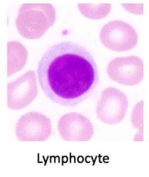 Lymphoid neoplasms Flashcards | Quizlet