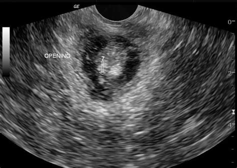 Fistula Ultrasound