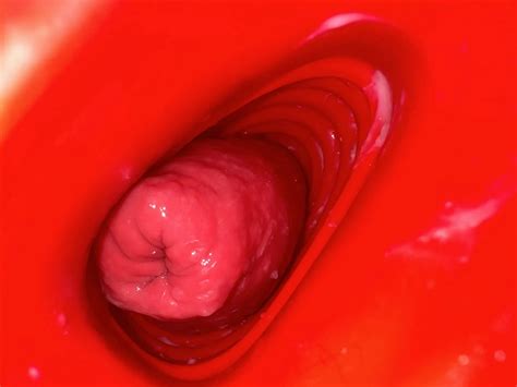 Anal Prolapse In Oxball Ff Pighole Nude Pics Xhamster