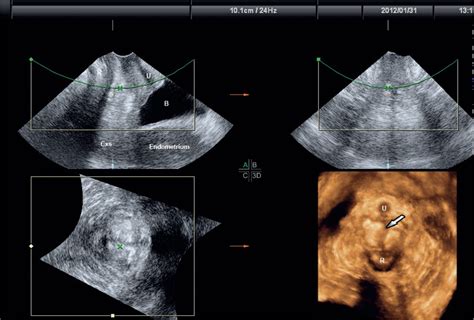 Three‐dimensional Ultrasound And Magnetic Resonance Imaging Assessment